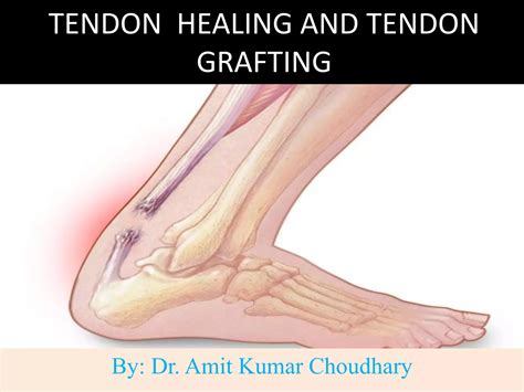 tendon healing  tendon grafting pptx