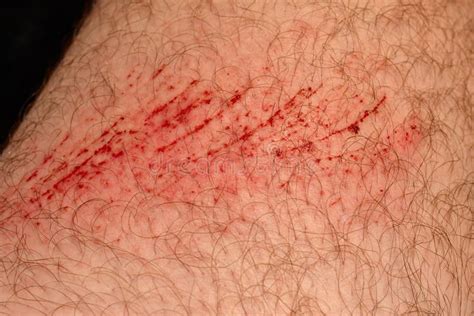 Peau D'éraflure, Blessure Ou Coupe Sur La Peau, Sang Rouge Partie Velue ...