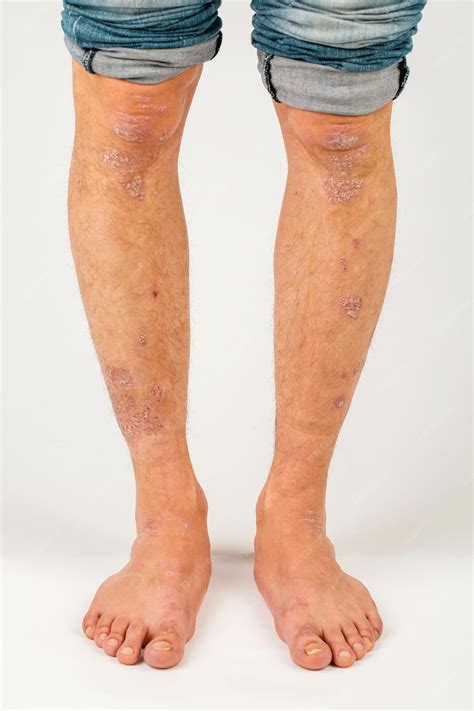 Premium Photo | Closeup of the legs of a man suffering from chronic