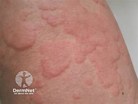 Urticaria and angioedema images (hives)