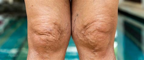 5 Proven Remedies To Banish Crepey Skin On Legs For A Smoother Summer