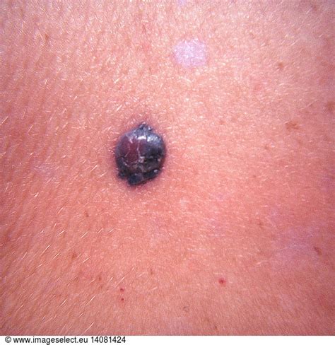 nodular malignant melanoma nodular malignant melanomaabnormal