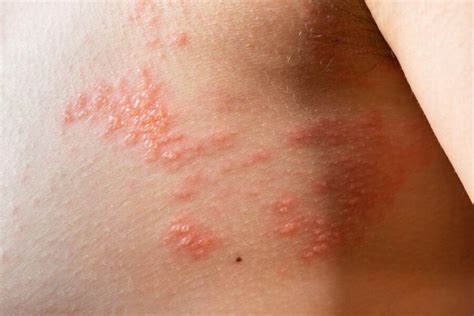 Does Shingles Leave Scars? Your Questions Answered - TheWellthieone