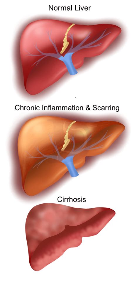Cirrhosis