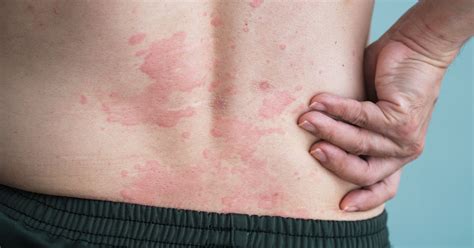 idiopathic urticaria chronic urticaria hives pef norge