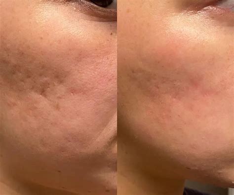 Acne Scars