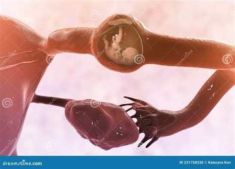 Tubal Ectopic Pregnancy, 3D Illustration Royalty-Free Cartoon ...