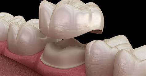 dental crown purpose types preparation procedure aftercare risks