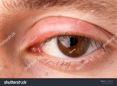 swollen eyelid macro stock photo  shutterstock