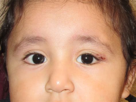 dermoid cyst child