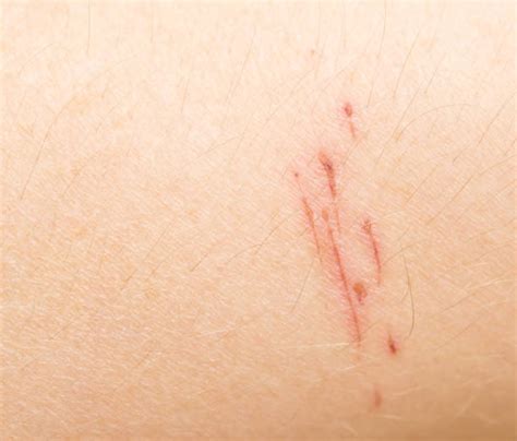 Scratch Mark Skin Stock Photos, Pictures & Royalty-Free Images - iStock