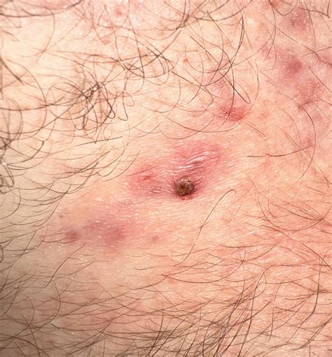 Is this a keloid forming? / What is the process of keloid formation ...
