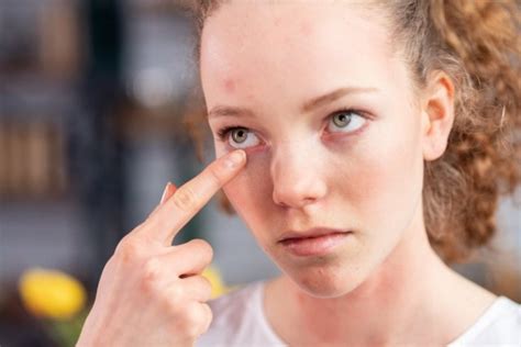 Мазь для век от аллергии: какие препараты могут назначаться? | MedAboutMe