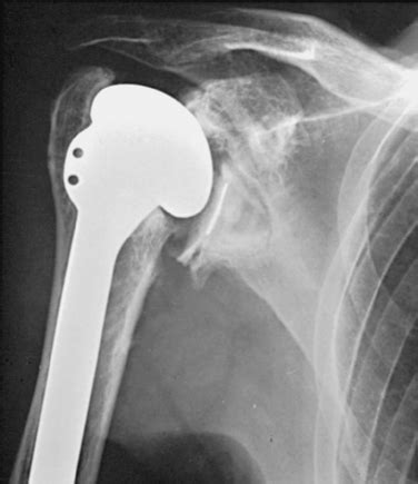 Biomechanics of the Shoulder | Musculoskeletal Key