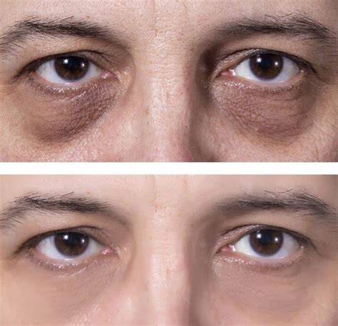 #1 Effective PRP Under Eyes Treatment For Hollows, Eye Bags, Dark Circles