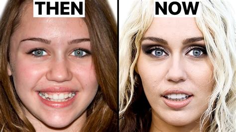 Miley Cyrus Surgery 2024: A Deep Dive Into The Pop Star's Recent ...