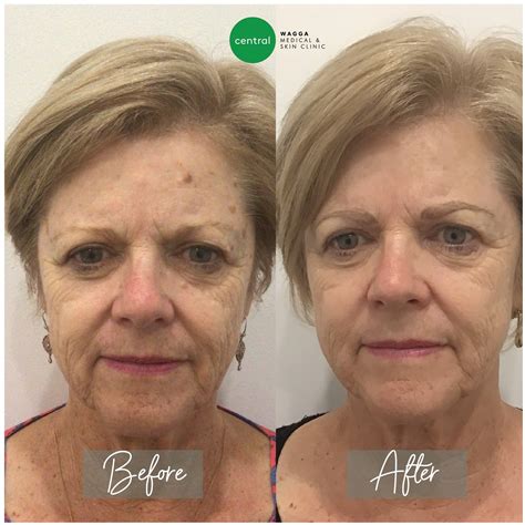 laser genesis central wagga medical skin cancer medical aesthetics
