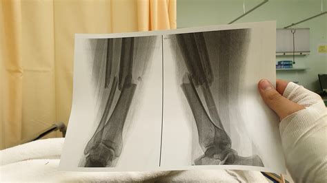 Tibia and fibula. Surgery needed. Was ATV'd and speedboated off Aegna