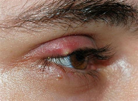 how to get rid of ingrown eyelash