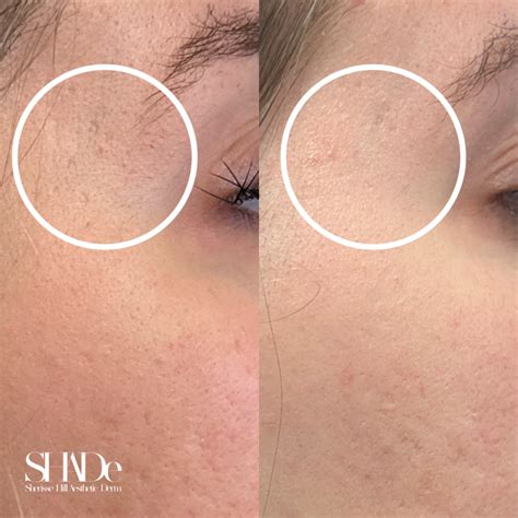 Before & After Photos for Microneedling in Issaquah, WA