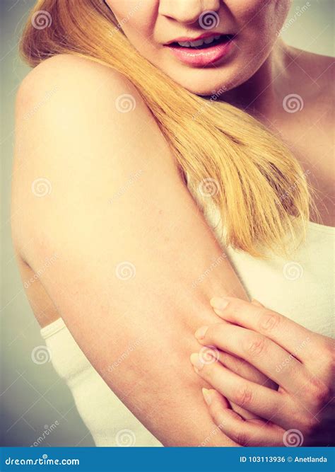 Woman Scratching Her Itchy Arm with Allergy Rash Stock Photo - Image of