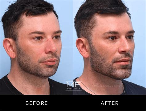 jawline filler  men transformative     mabrie