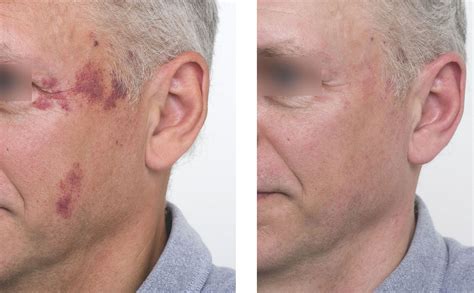 Before and after the treatment of a facial blemish with laser ...