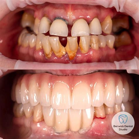 “All on four” Dental Implant method changed her life! – Berwick Dental ...
