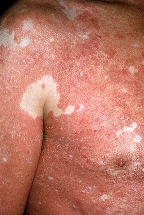 Pityriasis Rubra Pilaris - Skin Disorders - MSD Manual Consumer Version