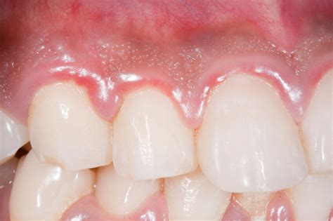 What is Gingivitis? Gingivitis Symptoms and Treatment