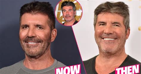 Simon Cowell Plastic Surgery Makeover Exposed By Top Docs