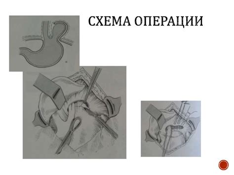 Диафрагмальные грыжи - презентация онлайн