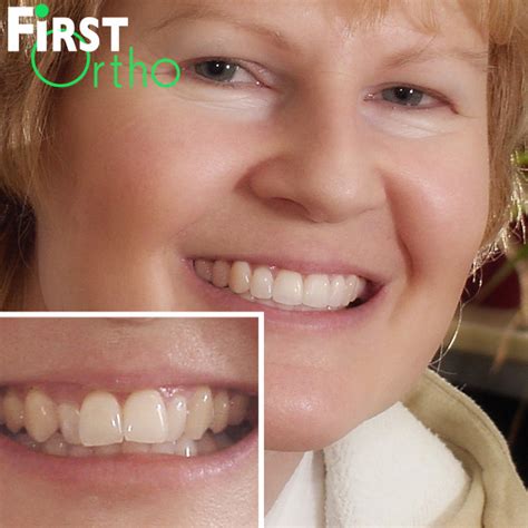 Adult Protrusion - First Ortho