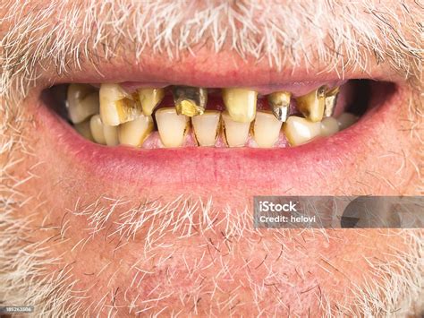 Bad Teeth Stock Photo - Download Image Now - Rudeness, Scurvy, Dentist ...