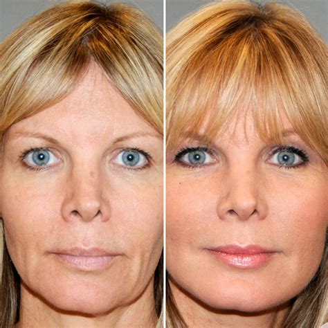 Hifu For A Double Chin: Everything You Need To Know | Justinboey