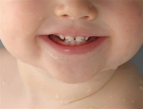Налет на зубах у ребенка 1-2 лет и больше: причины, почему возникает на ...