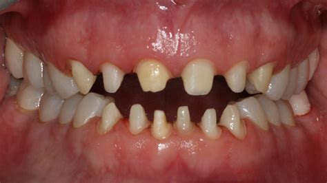 temporary crown    dr bharat katarmal dental