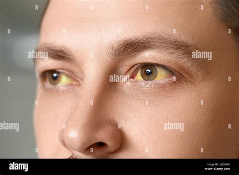 Man with yellow eyes, closeup. Hepatitis symptom Stock Photo - Alamy