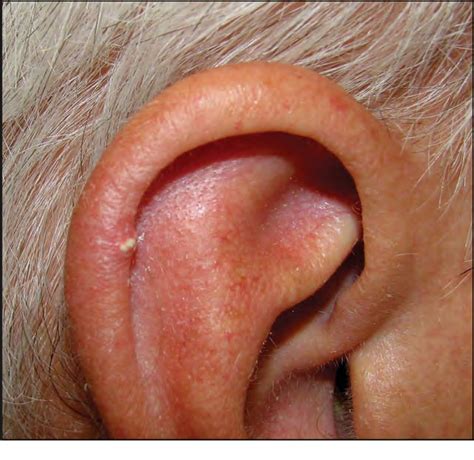 Tophus Ear