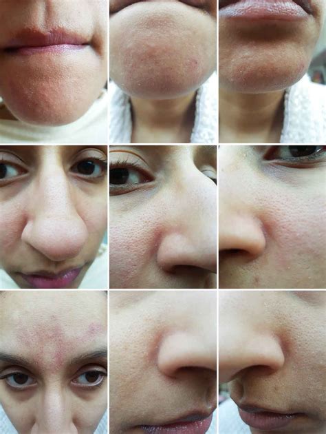 Unbelievable Blackhead Removal 2024: Before And After Photos That Will Shock You! Image 7