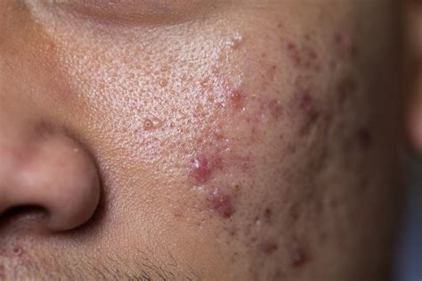 treatment  acne scars linia skin clinic