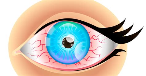 Suffer from Dry Eyes ? Visit WeLoveLenses.com