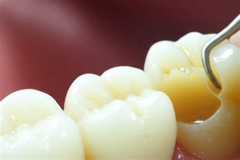 how to fix broken molar tooth