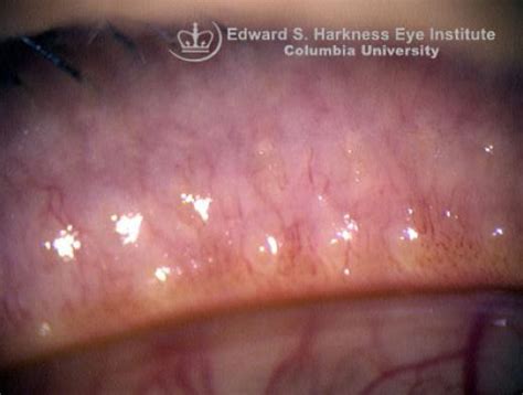 Chronic Meibomitis | Vagelos College of Physicians and Surgeons