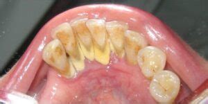 Why is Tartar Breaking Off Teeth?