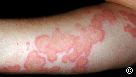 Vasculitis