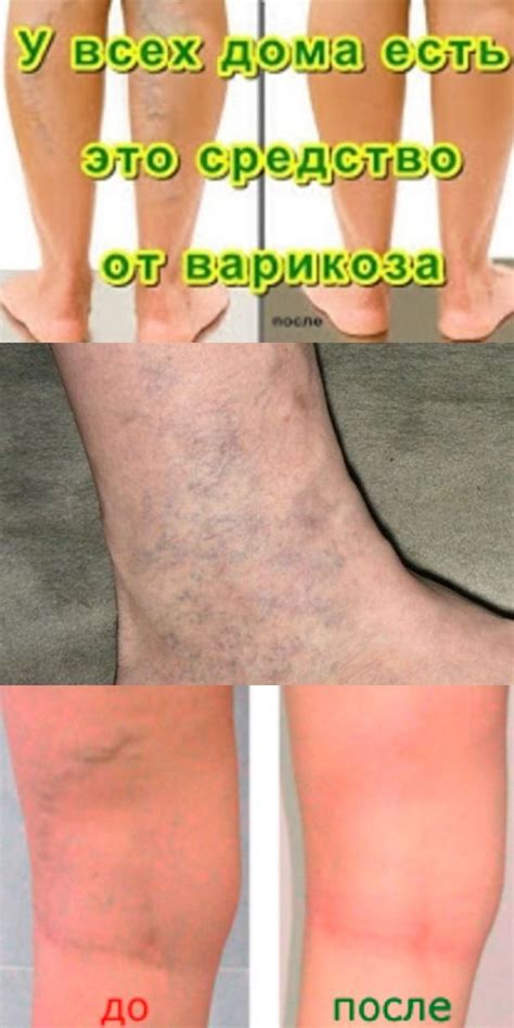 Полезные советы | Варикоз, Здоровье, Здоровье ног