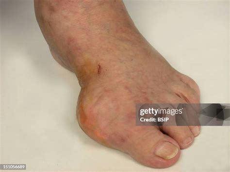 13 Tophus Stock Photos, High-Res Pictures, and Images - Getty Images