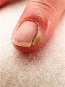 Cuticle Infection | LoveToKnow