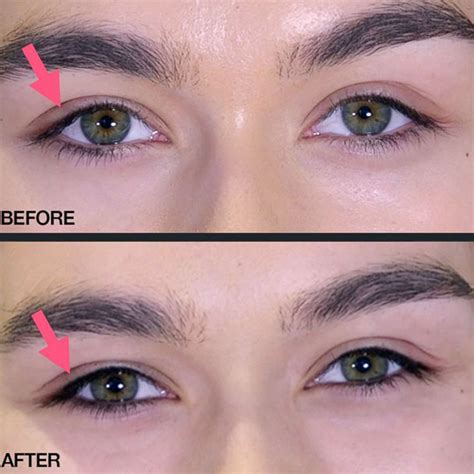 Eyeliner Permanent Makeup Before And After | Saubhaya Makeup